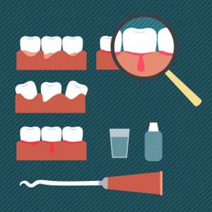 Кровоточат десна: народные средства, как лечить, что делать, между зубами