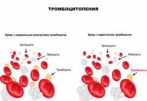 Тромбоцитопеническая пурпура: факторы риска, виды, развитие, диагностика, терапия, прогноз