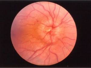 Ретробульбарный неврит зрительного нерва: симптомы, лечение, причины