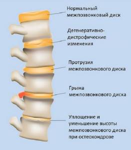 Боли под правой лопаткой сзади со спины — причины возникновения, лечение