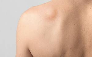 Шишка под кожей: причины появления уплотнения, как лечить