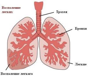 Пневмония без кашля: может ли быть, при каких условиях воспаление лёгких может протекать скрытно, по каким симптомам можно определить у взрослого человека, лечение