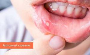 Лечение стоматита во рту у взрослых в домашних условиях: лекарства и лучшие народные средства, медикаментозные препараты
