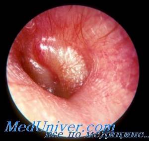 Мирингит: что это такое, симптомы и лечение острого в ухе, миринготомия
