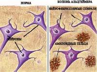 Профилактика болезни Альцгеймера: как предупредить нарушение у женщин и мужчин
