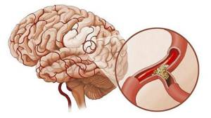 Склероз артерий головного мозга: признаки, диагностика, методы лечения