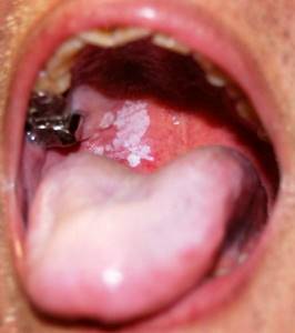 Рак полости рта: слизистой оболочки, щеки, неба, десны - симптомы онкологии ротовой полости, как выглядит