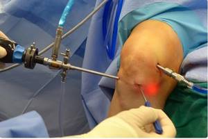 Артроскопия коленного сустава: что это такое, техника выполнения операции
