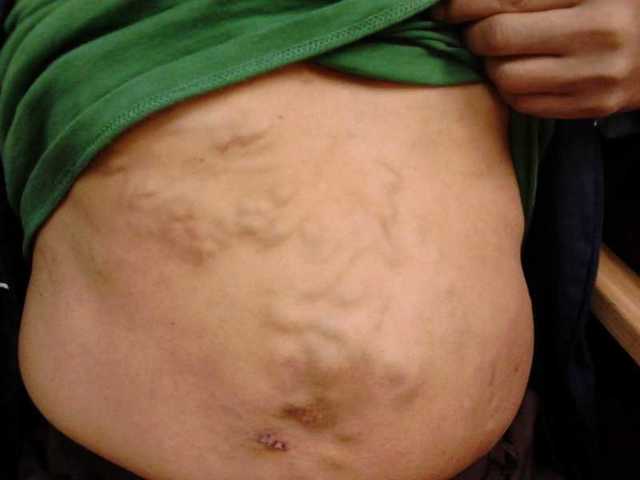 Синдром Бадда-Киари, тромбоз вен печени и печеночное кровоснабжение