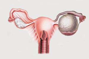Апоплексия (разрыв) яичника: симптомы, причины, последствия