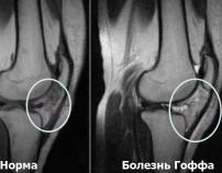 Болезнь Гоффа коленного сустава — лечение, симптомы, причины заболевания