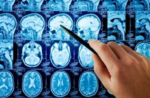 Неврологический осмотр (обследование неврологического больного): пробы, рефлексы, синдромы, инструментальные
