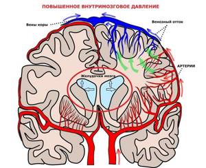 Головная боль при гипертонии: высокое давление и сильные головные боли, болит голова что делать