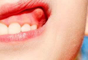 Как быстро снять опухоль от зубного флюса в домашних условиях: лечение, как снять отек на щеке