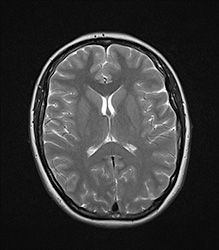 Кожевниковская (корковая) эпилепсия: причины, лечение, особенности припадков