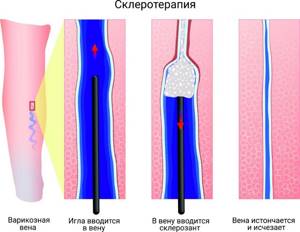Склеротерапия вен ног: эффективный метод для незапущенного варикоза