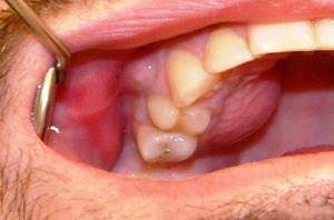 Антибиотики при флюсе зуба на десне и щеке для взрослых: какой пить, таблетки и лекарства при воспалении надкостницы
